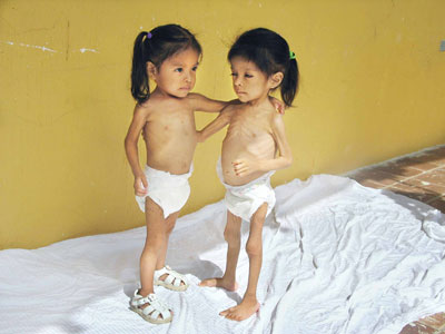 Two little girls when they were brought to an orphanage.